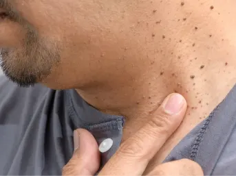 Stock photograph of a model: a man touches the side of his neck, which shows several dark moles