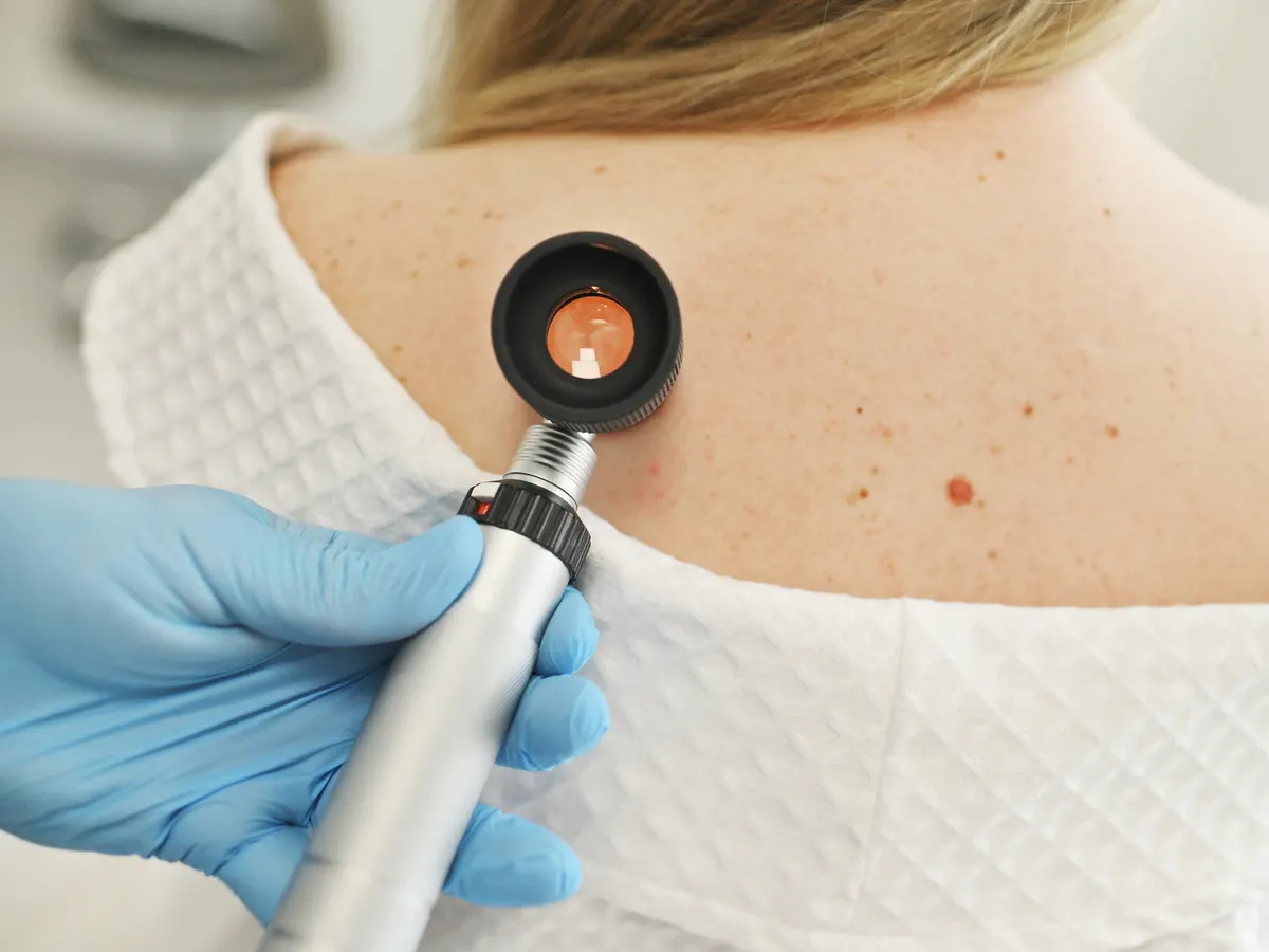 Stock photograph of models: a gloved hand holds a dermatoscope to the moles on a person's upper back