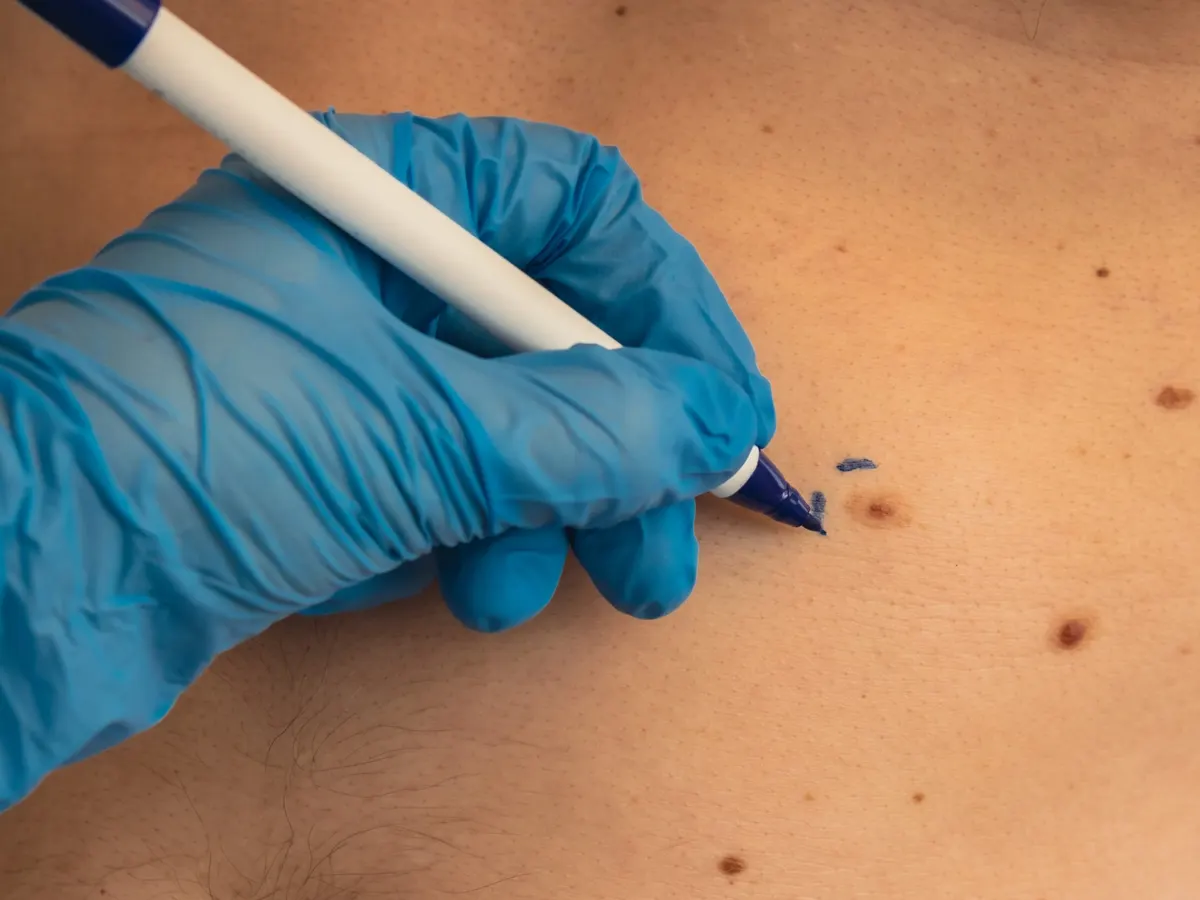 Surgeon's hands marking on someone's moles to check for skin cancer in Jacksonville, FL