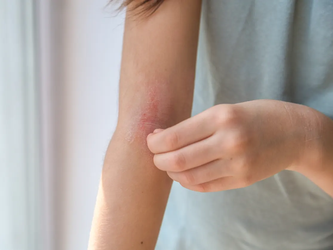 Stock photograph of a model: a person scratches a red, irritated patch of skin on the forearm