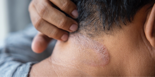 Stock photograph of a model: a hand holds back the hair on a man's neck, showing a patch of irritated skin