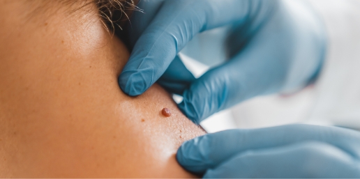 Stock photograph of models: blue-gloved hands hold the skin beside a small mole on a person's shoulder