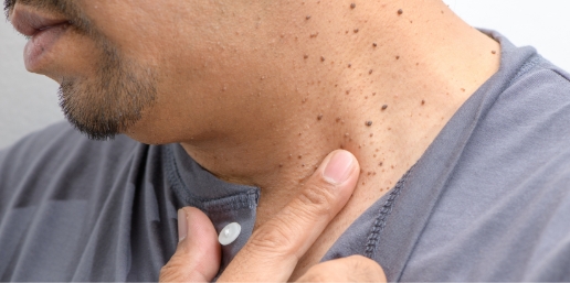 Stock photograph of a model: a man touches the side of his neck, which shows several dark moles