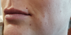 After Image: 1 ml of volbella and 1 ml of Juvederm ultra XC plus