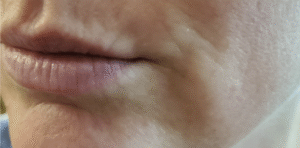 Before Image: 1 ml of volbella and 1 ml of Juvederm ultra XC plus