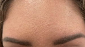After Image: Botox 11