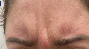 Before Image: Botox 11