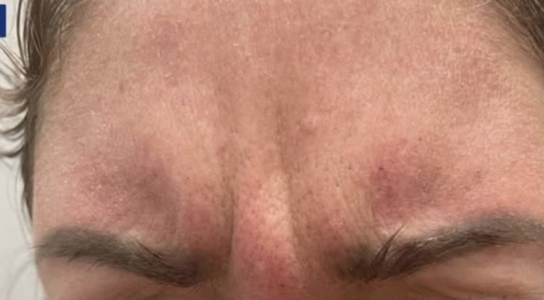 Before Image: Botox 11 - front