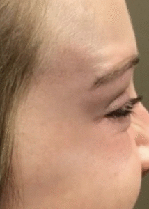 After Image: Botox Crow’s Feet