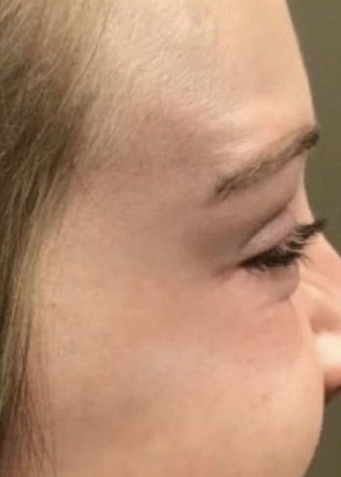 After Image: Botox Crow’s Feet - right-side