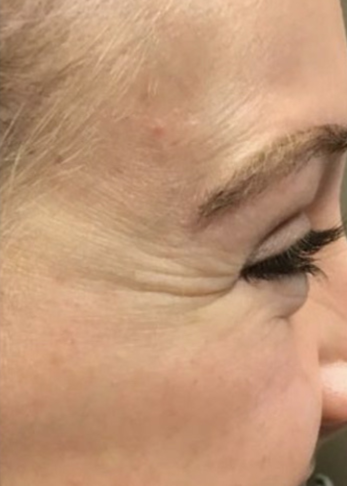 Before Image: Botox Crow’s Feet - right-side