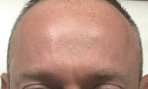 After Image: Botox Forehead