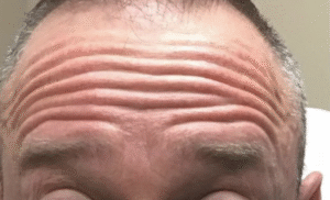 Before Image: Botox Forehead