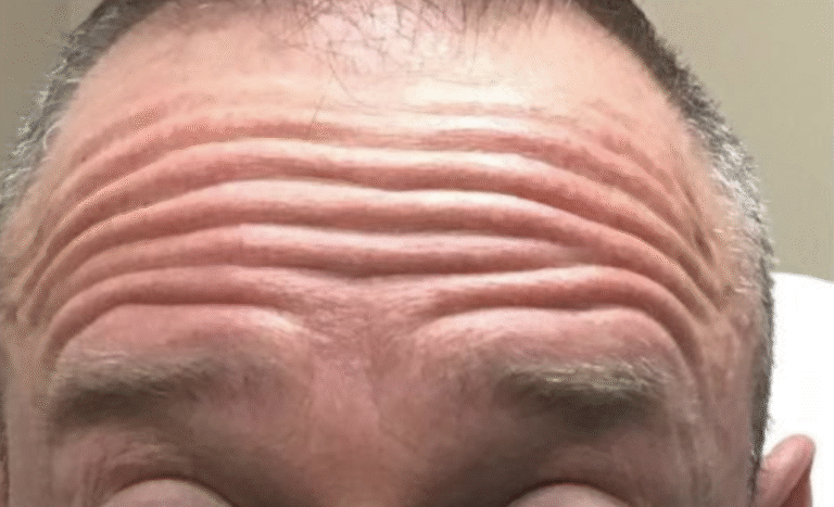 Before Image: Botox Forehead - front