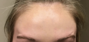 After Image: Botox Forehead Female
