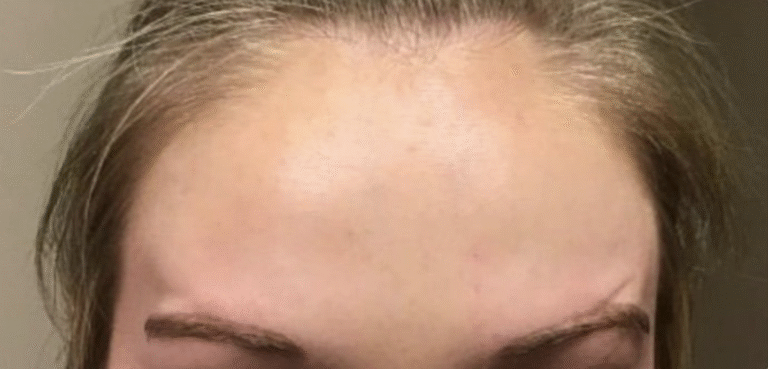 After Image: Botox Forehead Female - front