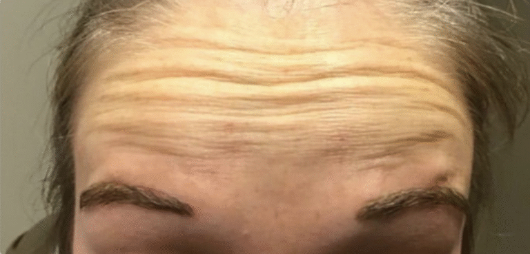 Before Image: Botox Forehead Female - front