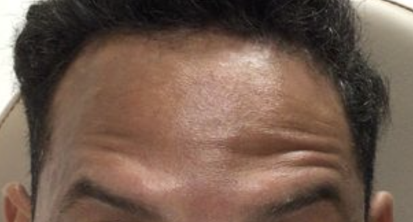 After Image: Botox Forehead Male - front