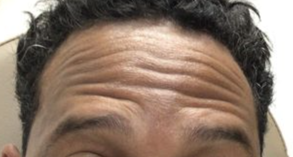 Before Image: Botox Forehead Male - front