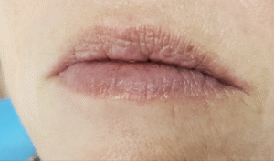 Before Image: Juvéderm Ultra XC plus Lips