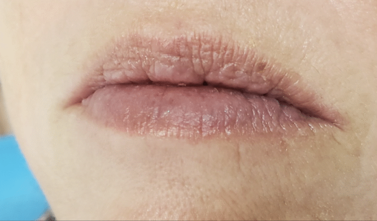 Before Image: Juvéderm Ultra XC plus Lips - front
