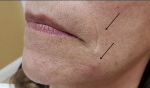 After Image: Juvéderm Ultra XC plus