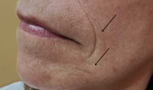 Before Image: Juvéderm Ultra XC plus