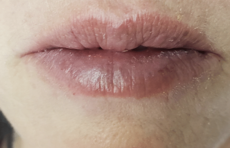 After Image: Juvéderm Ultra XC plus Lips - front
