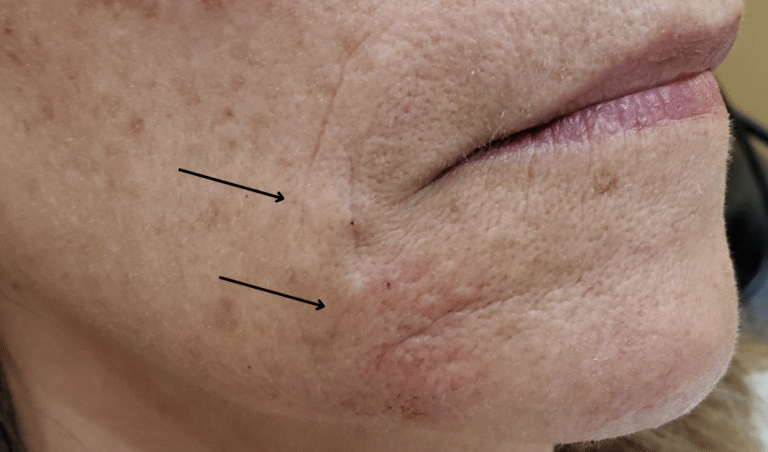 After Image: Juvéderm Volbella 1 ml - right-front-oblique