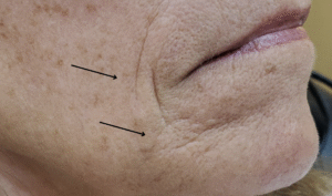 Before Image: Juvéderm Volbella 1 ml