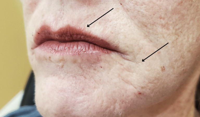 After Image: Juvéderm Volbella 1 ml - left-front-oblique