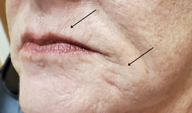 Before Image: Juvéderm Volbella 1 ml - left-front-oblique