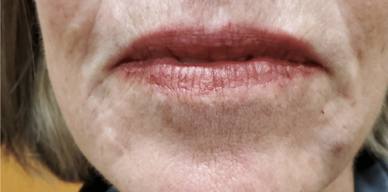 After Image: Marionette lines 1ml Juverderm ultra xc plus - front