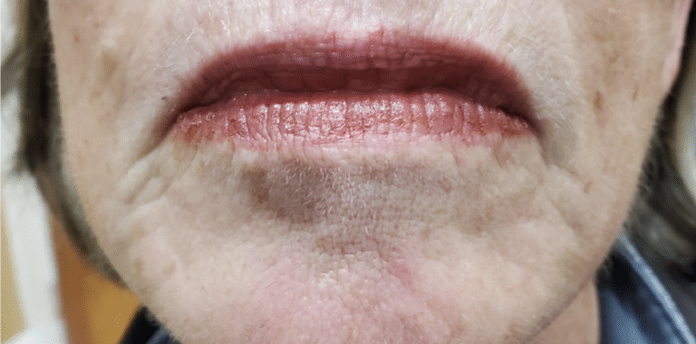 Before Image: Marionette lines 1ml Juverderm ultra xc plus - front