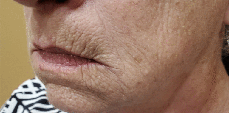 After Image: Volbella 1.55ml - left-front-oblique