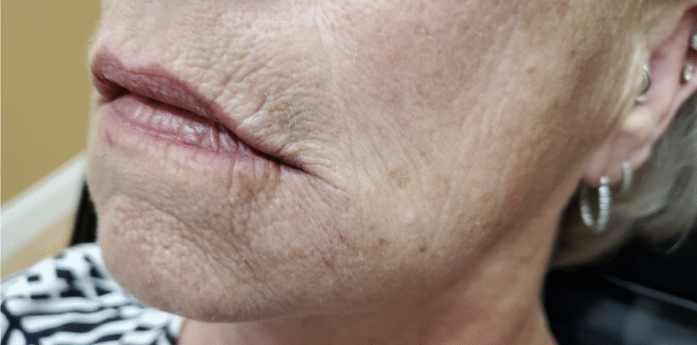 Before Image: Volbella 1.55ml - left-front-oblique