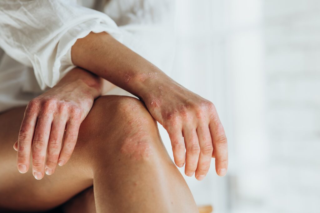 Woman with psoriasis on her knees in Jacksonville, FL