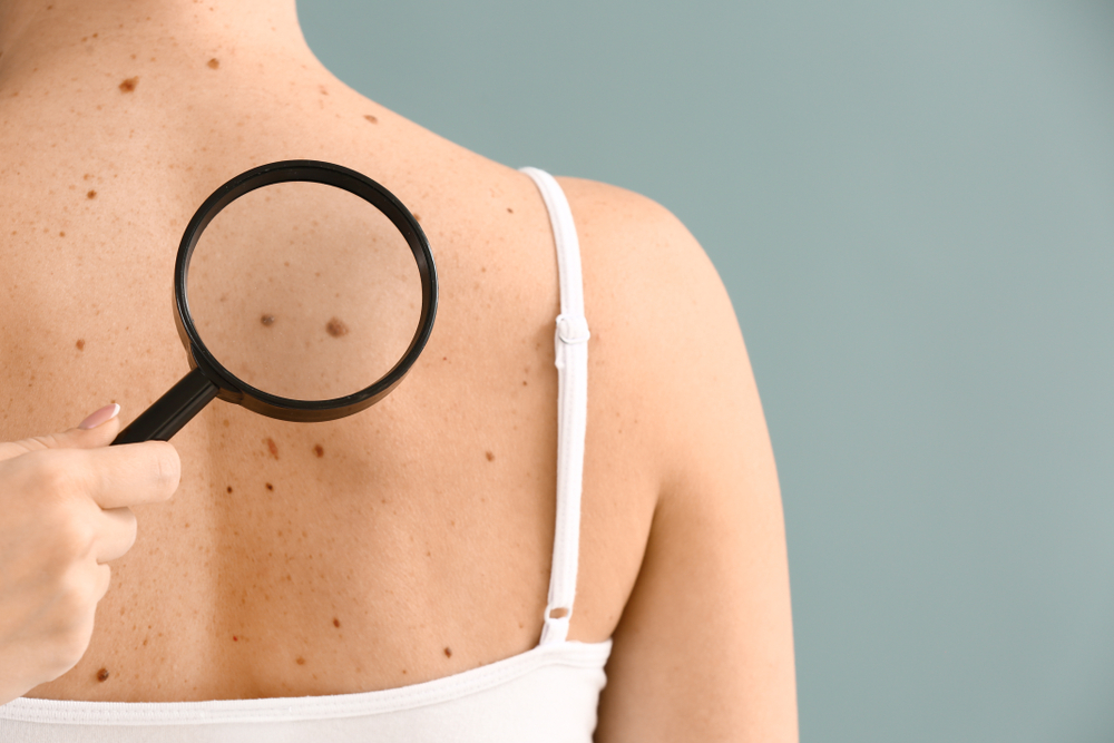 Woman with moles on her back being inspected for skin cancer in Jacksonville, FL