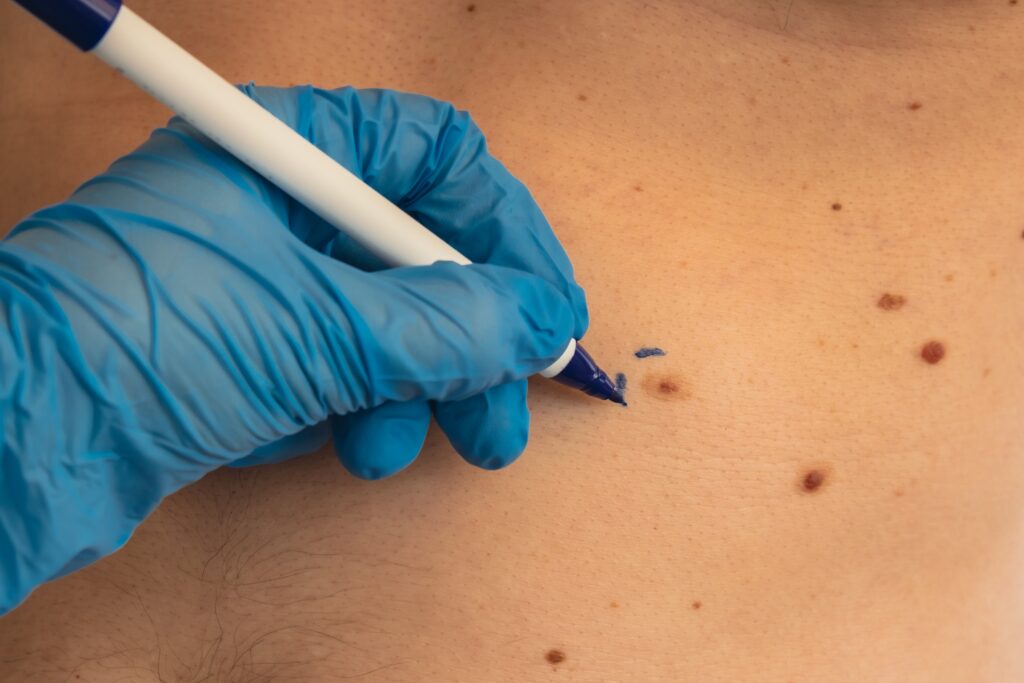 Surgeon's hands marking on someone's moles to check for skin cancer in Jacksonville, FL