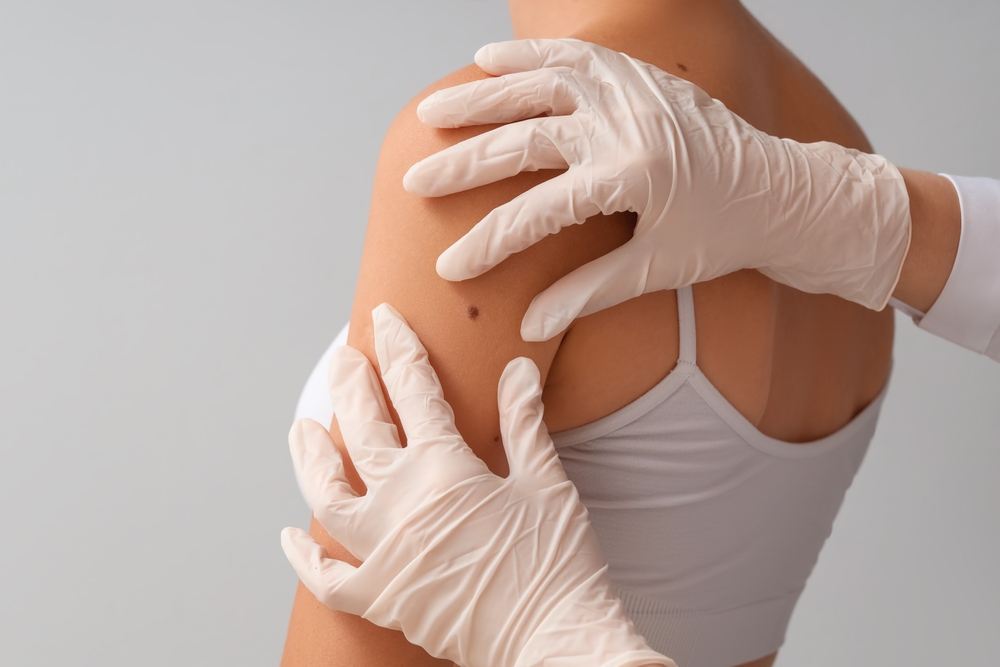 Doctor examining a wart for removal in Jacksonville, FL