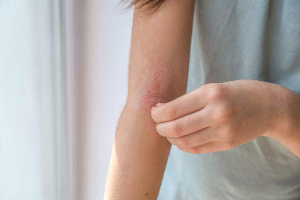 Woman scratching her elbow due to psoriasis.